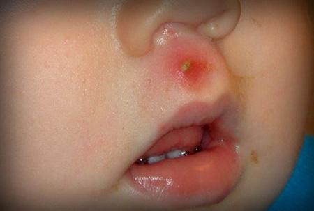 Самая опасная локализация фурункула – верхняя губа, носогубный треугольник, откуда инфекция может легко попасть в мозг