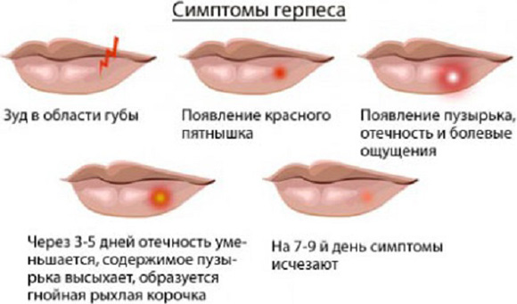 При ослаблении иммунитета вирус проявляется в виде высыпаний на губах