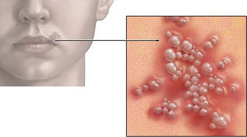 Пузырьки герпеса начинают появляться при снижении иммунитета