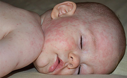 Типичные проявления детской розеолы при герпесе 6 типа: ребенок спокоен, зуда нет, сон не нарушен