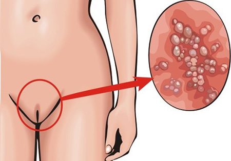 Генитальный герпес поражает кожу и слизистые оболочки половых органов