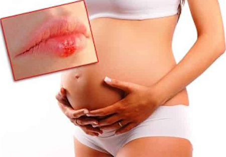 Герпесвирусная инфекция может проявиться на любом сроке беременности