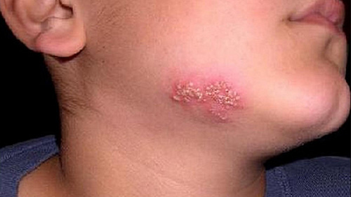 Герпес может поражать не только слизистую губ, но и другие части лица
