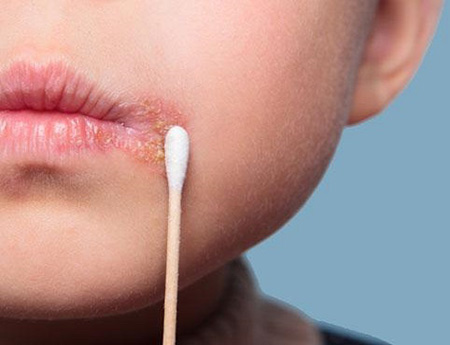 Чаще всего высыпания возникают на губах и возле них. Если начать лечение сразу же при первых признаках, появление пузырьков можно предотвратить.