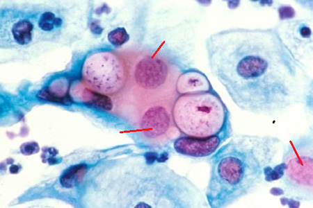Клетки крови – Т-лимфоциты, пораженные вирусом герпеса 6 типа