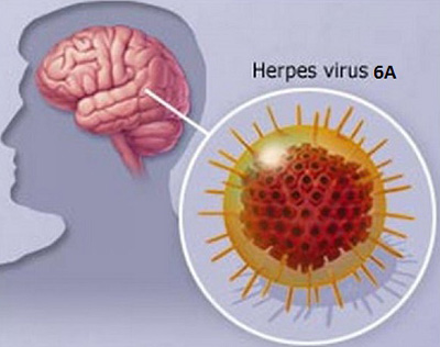Вирус герпеса 6 типа поражает оболочки клеток головного и спинного мозга, вызывая рассеянный склероз