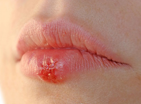 Самым частым и распространенным проявлением герпеса считаются высыпания на губах