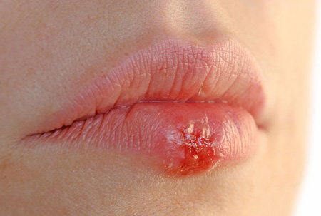 Герпес на губах или в носу – наиболее распространенный вид вирусной инфекции