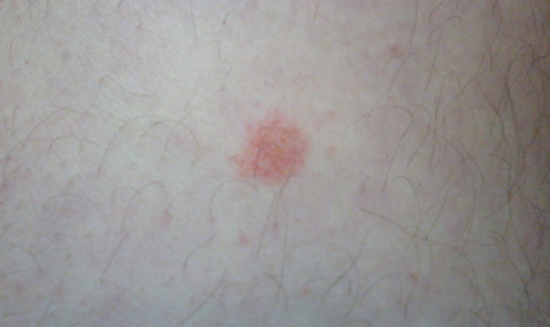 Небольшое красное пятнышко может стать предвестником многих кожных патологий
