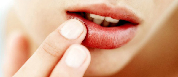 Высыпания на губах - источник распространения вируса