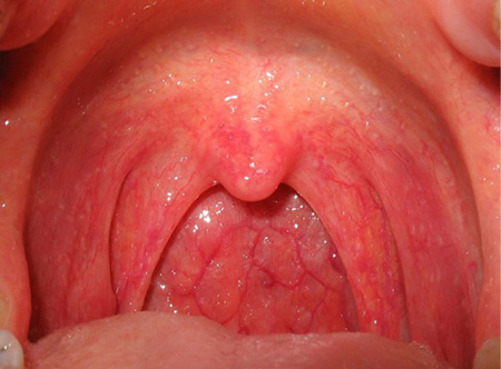 Онкология лимфоидных тканей начинается с болей в горле и скачков температуры