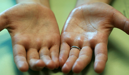 Повышенная потливость рук может быть связана с некоторыми заболеваниями