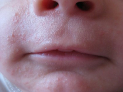Повышенное потоотделение у маленьких детей вызывает раздражения на коже и неприятный зуд