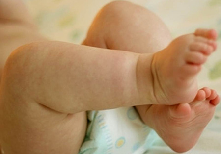 Часто у малыша потеют только ножки, голова и ручки. Это – признаки локального гипергидроза