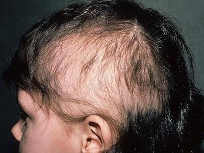 Образование коросты на голове в волосах может приводить не только к повышенной ломкости волос, но и к их потере