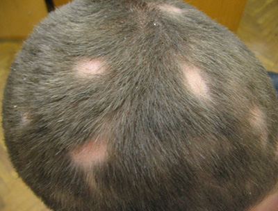 Клиническая картина сопровождается появлением от одного до нескольких участков облысения на волосистой части головы округлой или овальной формы. Размеры от 2-3 см до 10-15 см в диаметре.