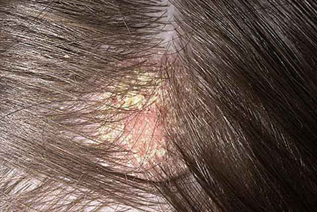 Клинически себорейная алопеция проявляется образованием шелушащихся корочек у основания волос. Характерно наличие сильного зуда. После обламывания волос остается зона облысения, расширяющаяся по мере прогрессирования заболевания.