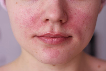 При кожных заболеваниях (дрожжевой грибок и др.) в области лица часто фиксируется покраснение