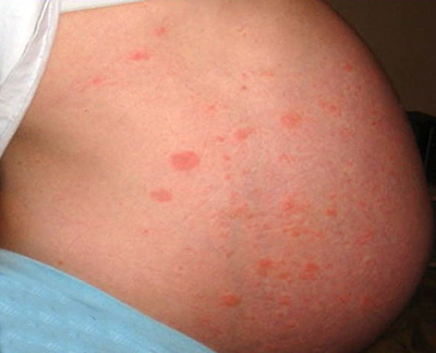 Во время беременности многие внешние факторы могут спровоцировать проявления крапивницы