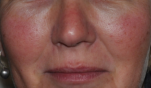 Кроме носа, купероз часто появляется и на щеках