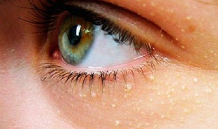 Удаление жировиков в области глаз лучше доверить косметологу, не пытаясь избавиться от кожного дефекта самостоятельно