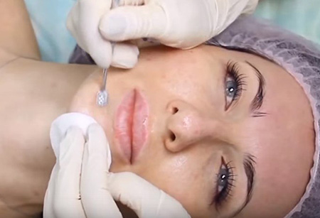 Перед началом механической чистки косметолог наносит на лицо пациента успокаивающую маску, способствующую расширению пор