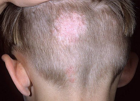 Стригущий лишай имеет такое название по причине выпадения волос в месте поражения