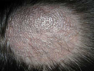 Чаще всего очаги локализуются на коже головы под волосами, образуя округлые проплешины. Размеры пораженного участка бывают различными, достигая значительной величины.