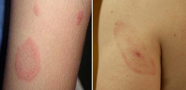 Материнская бляшка при розовом лишае (фото слева) и розеола при сифилисе (фото справа) могут быть похожими