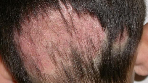 Поражение волосистой части головы при стригущем лишае вызывает серьёзные косметические дефекты