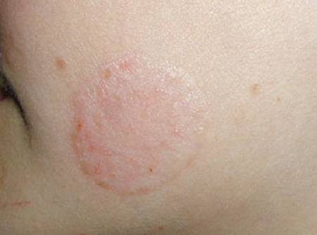Трихофития, или стригущий лишай, проявляется в виде отёчных областей, заключённых в кайму пузырьков или корочек. В центре заражённой области заметно шелушение кожи.