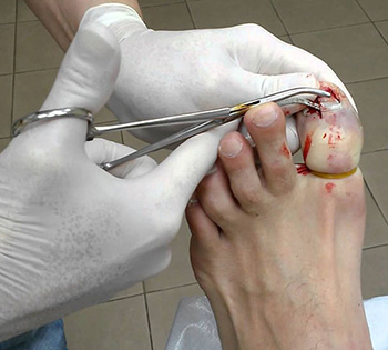 Удаление ногтя хирургическим путем - наиболее радикальный метод, применяемый для избавления от инфекции