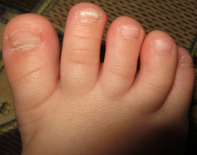 Грибок ногтей у детей может проявляться с первого месяца жизни