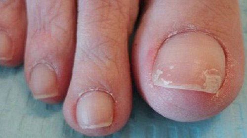 Появление белых пятен на ногтевой пластинке свидетельствует о начальной стадии онихомикоза