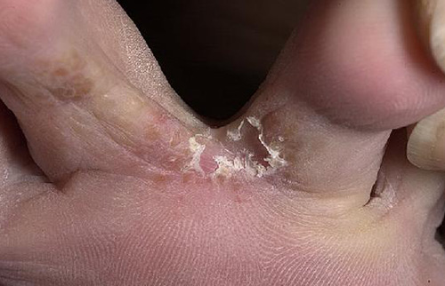 Чаще всего поражение грибком начинается между пальцами ног. В дальнейшем оно переходит на ногти, вызывая их разрушение.
