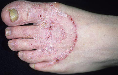 Если не заняться лечением микоза на ранних стадиях, вскоре грибок перейдёт с ногтевых пластин на кожу и будет развиваться, разрушая её