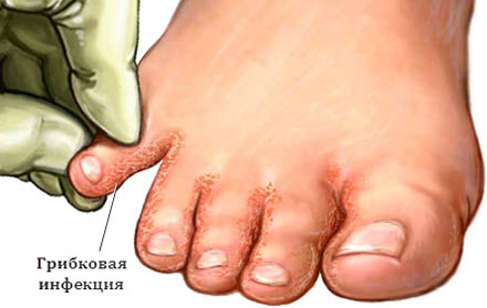 Необходимо регулярно обрабатывать стопы ног, снимать ороговевший слой, закрывать путь инфекции