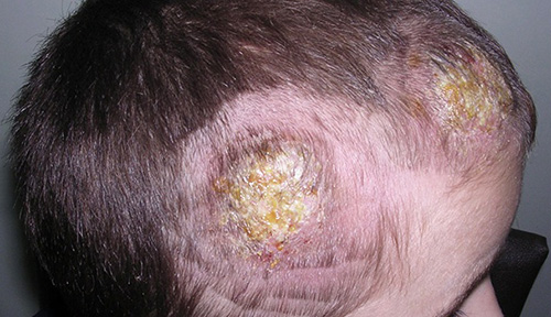 Состригание или сбривание волос вокруг пораженного места предупреждает распространение микоза