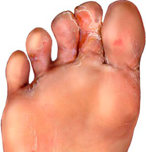 При отсутствии лечения грибковая инфекция быстро распространяется по стопе и пальцам ног