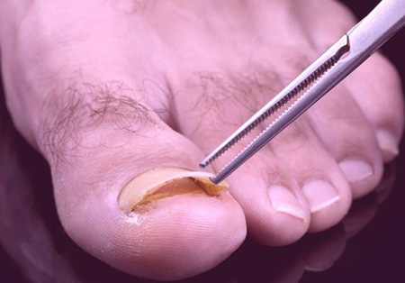При удалении заболевшей ногтевой пластины лечение будет быстрее и эффективнее