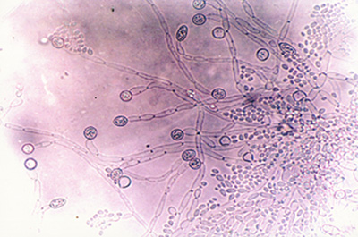 Возбудитель онихомикоза – грибы рода Candida. Вид грибов под микроскопом
