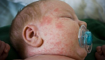 При внутриутробном воздействии аллергенов признаки нейродермита зачастую проявляются уже в младенческом возрасте