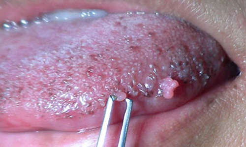 Папилломавирус слизистой оболочки ротовой полости