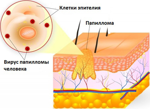 Чистотел действует на эпителиальные клетки папилломы и на находящиеся внутри них папилломавирусы