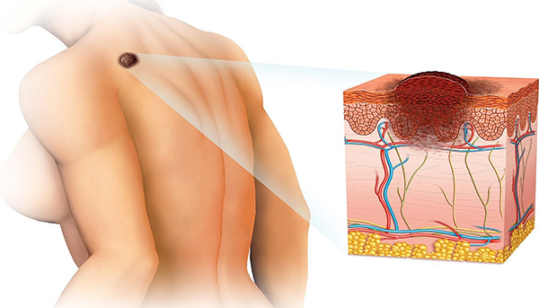 Развиваясь, папилломавирус проникает через базальные ткани в глубокие слои кожи