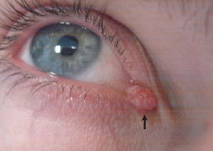 Папиллома в области слезного сосочка может нарушать поступление слезы и смачивание глаза