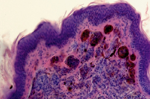 При гистологическом исследовании наблюдается изменение эпидермиса по типу папилломатоза и гиперкератоза. Также имеется обилие меланоцитов (коричневые клетки) в верхних слоях дермы.