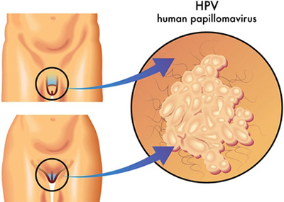 ВПЧ может спровоцировать развитие рака пениса и ануса