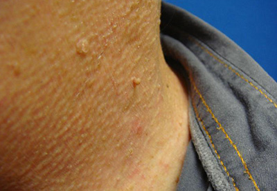 Папиллома является самым распространенным доброкачественным кожным новообразованием