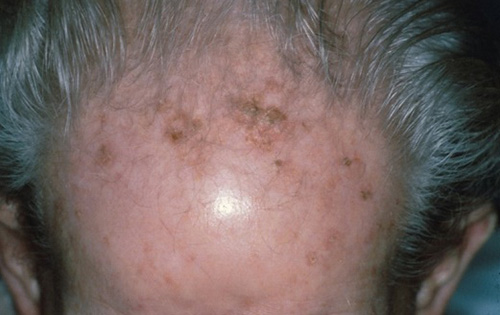 Множественные кератопапилломы (кератоз) кожи головы, возникающие в старческом возрасте